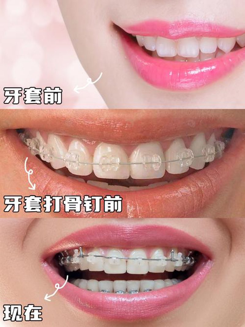 拔智齿