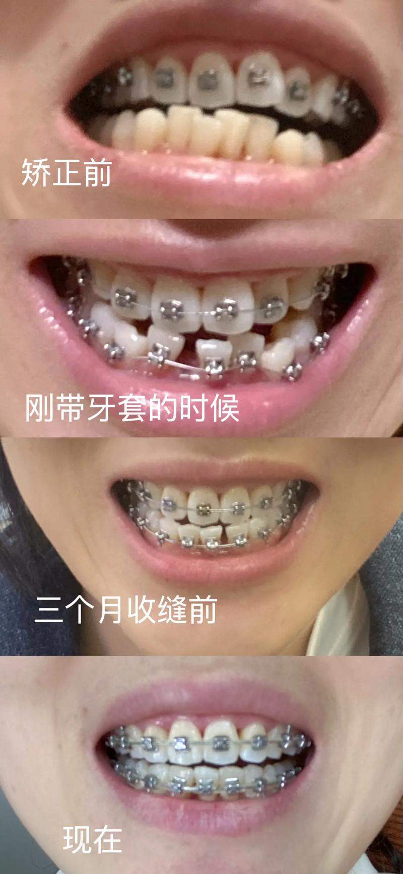 选择适合的大同种植牙：一份全面的指南