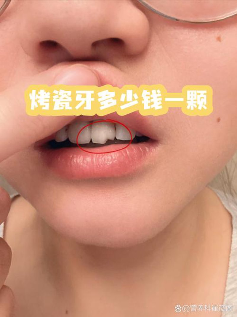 烤瓷牙技术革新：引领口腔美容新潮流